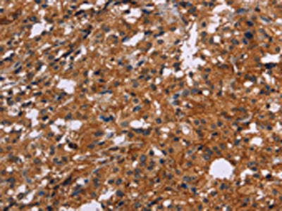 The image on the left is immunohistochemistry of paraffin-embedded Human thyroid cancer tissue using the antibody Antibody) at dilution 1/20, on the right is treated with synthetic peptide. (Original magnification: ×200)Rabbit anti-Human EGR4 Polyclonal Antibody