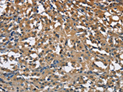 The image on the left is immunohistochemistry of paraffin-embedded Human thyroid cancer tissue using ENO1 Antibody(ENO1 Antibody) at dilution 1/40, on the right is treated with fusion protein. (Original magnification: ×200)Rabbit anti-Human ENO1 Polyclonal Antibody