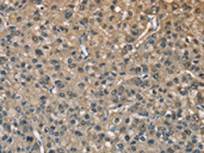 The image on the left is immunohistochemistry of paraffin-embedded Human liver cancer tissue using the antibody Antibody) at dilution 1/40, on the right is treated with fusion protein. (Original magnification: ×200)Rabbit anti-Human ENO1 Polyclonal Antibody