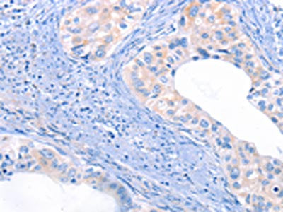 The image on the left is immunohistochemistry of paraffin-embedded Human cervical cancer tissue using THBS1 Antibody(THBS1 Antibody) at dilution 1/50, on the right is treated with synthetic peptide. (Original magnification: ×200)Rabbit anti-Human THBS1 Polyclonal Antibody