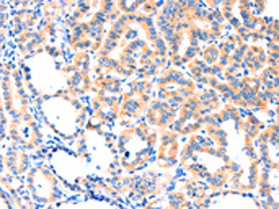 The image on the left is immunohistochemistry of paraffin-embedded Human thyroid cancer tissue using the antibody Antibody) at dilution 1/50, on the right is treated with synthetic peptide. (Original magnification: ×200)Rabbit anti-Human THBS1 Polyclonal Antibody