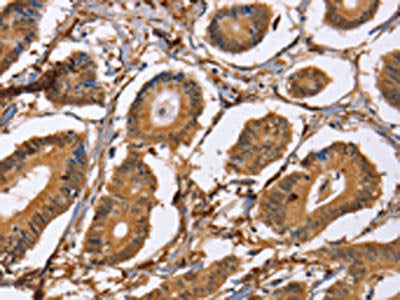 The image on the left is immunohistochemistry of paraffin-embedded Human colon cancer tissue using LXN Antibody(LXN Antibody) at dilution 1/25, on the right is treated with fusion protein. (Original magnification: ×200)