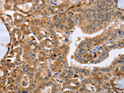 The image on the left is immunohistochemistry of paraffin-embedded Human thyroid cancer tissue using the antibody Antibody) at dilution 1/25, on the right is treated with fusion protein. (Original magnification: ×200)