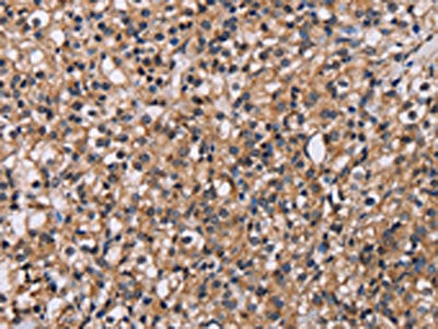 The image on the left is immunohistochemistry of paraffin-embedded Human prostate cancer tissue using GNL3 Antibody(GNL3 Antibody) at dilution 1/60, on the right is treated with fusion protein. (Original magnification: ×200)Rabbit anti-Human GNL3 Polyclonal Antibody