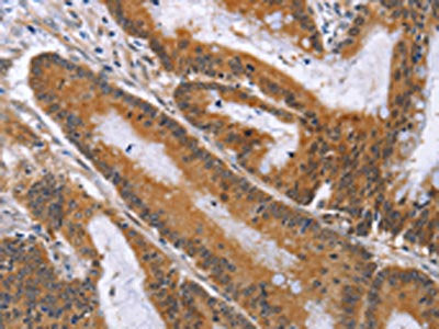 The image on the left is immunohistochemistry of paraffin-embedded Human colon cancer tissue using ACVR2B Antibody(ACVR2B Antibody) at dilution 1/50, on the right is treated with fusion protein. (Original magnification: ×200)Rabbit anti-Human ACVR2B Polyclonal Antibody