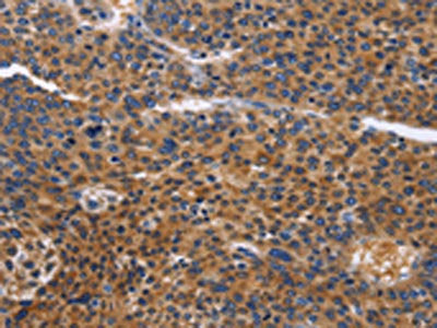 The image on the left is immunohistochemistry of paraffin-embedded Human liver cancer tissue using the antibody Antibody) at dilution 1/50, on the right is treated with fusion protein. (Original magnification: ×200)