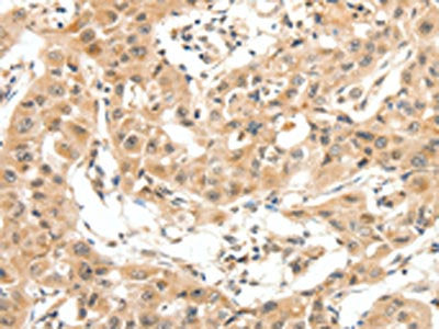 The image on the left is immunohistochemistry of paraffin-embedded Human lung cancer tissue using MAP3K14 Antibody(MAP3K14 Antibody) at dilution 1/20, on the right is treated with fusion protein. (Original magnification: ×200)