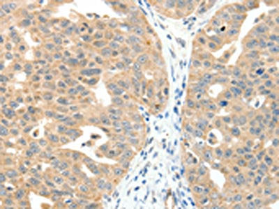 The image on the left is immunohistochemistry of paraffin-embedded Human ovarian cancer tissue using the antibody Antibody) at dilution 1/20, on the right is treated with fusion protein. (Original magnification: ×200)