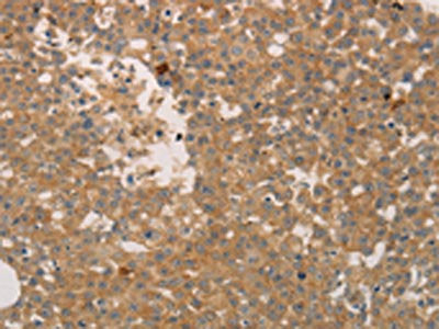 The image on the left is immunohistochemistry of paraffin-embedded Human breast cancer tissue using ADCYAP1R1 Antibody(ADCYAP1R1 Antibody) at dilution 1/70, on the right is treated with synthetic peptide. (Original magnification: ×200)Rabbit anti-Human ADCYAP1R1 Polyclonal Antibody
