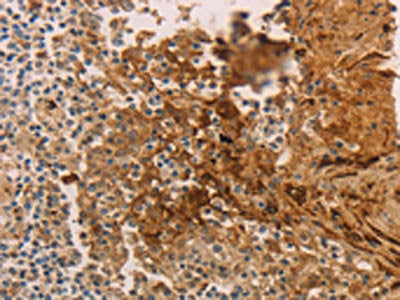 The image on the left is immunohistochemistry of paraffin-embedded Human tonsil tissue using the antibody Antibody) at dilution 1/70, on the right is treated with synthetic peptide. (Original magnification: ×200)Rabbit anti-Human ADCYAP1R1 Polyclonal Antibody