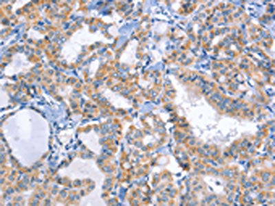 The image on the left is immunohistochemistry of paraffin-embedded Human thyroid cancer tissue using DUSP10 Antibody(DUSP10 Antibody) at dilution 1/20, on the right is treated with fusion protein. (Original magnification: ×200)Rabbit anti-Human DUSP10 Polyclonal Antibody