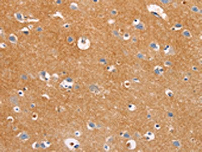 The image on the left is immunohistochemistry of paraffin-embedded Human brain tissue using the antibody Antibody) at dilution 1/20, on the right is treated with fusion protein. (Original magnification: ×200)Rabbit anti-Human DUSP10 Polyclonal Antibody
