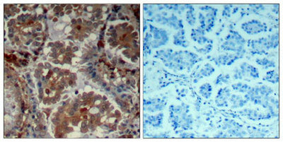 Immunohistochemical analysis of paraffin-embedded human Lung carcinoma tissue using mTOR(Ab-2448) Antibody(left) or the same antibody preincubated with blocking peptide(right).Rabbit anti-Human MTOR Polyclonal Antibody