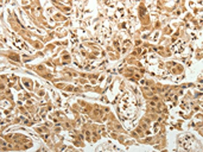 The image on the left is immunohistochemistry of paraffin-embedded Human lung cancer tissue using SPATA17 Antibody(SPATA17 Antibody) at dilution 1/25, on the right is treated with fusion protein. (Original magnification: ×200)Rabbit anti-Human SPATA17 Polyclonal Antibody
