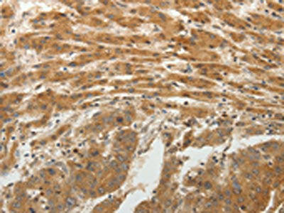 The image on the left is immunohistochemistry of paraffin-embedded Human liver cancer tissue using the antibody Antibody) at dilution 1/25, on the right is treated with fusion protein. (Original magnification: ×200)Rabbit anti-Human SPATA17 Polyclonal Antibody