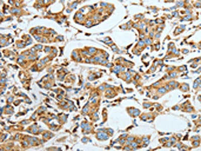 The image on the left is immunohistochemistry of paraffin-embedded Human breast cancer tissue using ASAH1 Antibody(ASAH1 Antibody) at dilution 1/40, on the right is treated with fusion protein. (Original magnification: ×200)Rabbit anti-Human ASAH1 Polyclonal Antibody