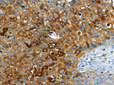 The image on the left is immunohistochemistry of paraffin-embedded Human cervical cancer tissue using the antibody Antibody) at dilution 1/40, on the right is treated with fusion protein. (Original magnification: ×200)