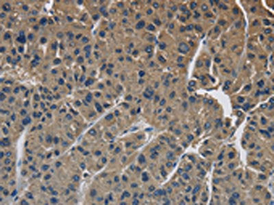 The image is immunohistochemistry of paraffin-embedded Human liver cancer tissue using SIGMAR1 Antibody(SIGMAR1 Antibody) at dilution 1/50. (Original magnification: ×200)Rabbit anti-Human SIGMAR1 Polyclonal Antibody