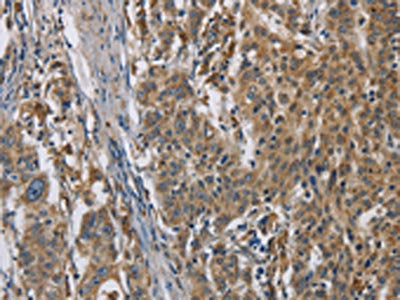 The image is immunohistochemistry of paraffin-embedded Human gastic cancer tissue using the antibody Antibody) at dilution 1/50. (Original magnification: ×200)Rabbit anti-Human SIGMAR1 Polyclonal Antibody