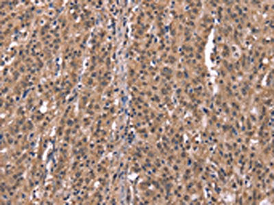 The image on the left is immunohistochemistry of paraffin-embedded Human gastric cancer tissue using HRH1 Antibody(HRH1 Antibody) at dilution 1/40, on the right is treated with synthetic peptide. (Original magnification: ×200)Rabbit anti-Human HRH1 Polyclonal Antibody
