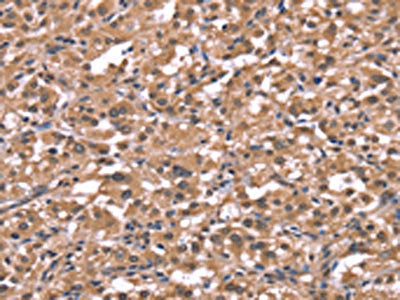 The image on the left is immunohistochemistry of paraffin-embedded Human thyroid cancer tissue using the antibody Antibody) at dilution 1/40, on the right is treated with synthetic peptide. (Original magnification: ×200)Rabbit anti-Human HRH1 Polyclonal Antibody