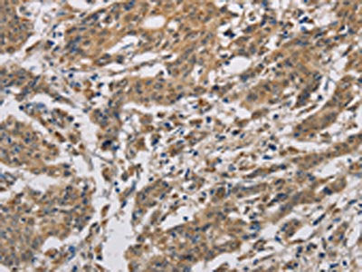 The image is immunohistochemistry of paraffin-embedded Human gastric cancer tissue using CYCS Antibody(CYCS Antibody) at dilution 1/50. (Original magnification: ×200)Rabbit anti-Human CYCS Polyclonal Antibody