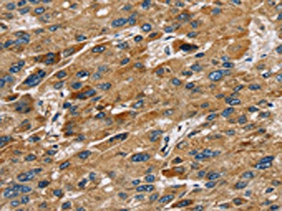 The image on the left is immunohistochemistry of paraffin-embedded Human liver cancer tissue using SULT1B1 Antibody(SULT1B1 Antibody) at dilution 1/30, on the right is treated with fusion protein. (Original magnification: ×200)Rabbit anti-Human SULT1B1 Polyclonal Antibody