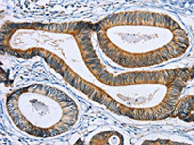 The image on the left is immunohistochemistry of paraffin-embedded Human colon cancer tissue using the antibody Antibody) at dilution 1/30, on the right is treated with fusion protein. (Original magnification: ×200)Rabbit anti-Human SULT1B1 Polyclonal Antibody