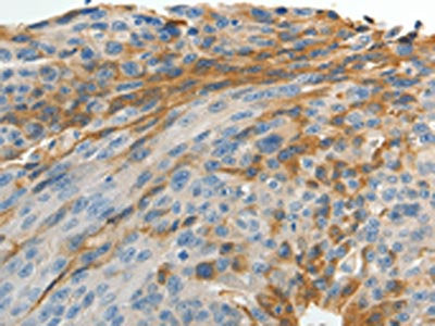 The image on the left is immunohistochemistry of paraffin-embedded Human ovarian cancer tissue using MAD2L1 Antibody(MAD2L1 Antibody) at dilution 1/25, on the right is treated with fusion protein. (Original magnification: ×200)