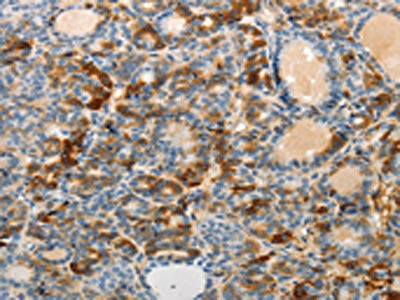 The image on the left is immunohistochemistry of paraffin-embedded Human thyroid cancer tissue using the antibody Antibody) at dilution 1/25, on the right is treated with fusion protein. (Original magnification: ×200)