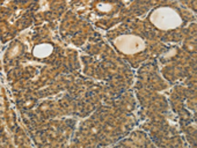 The image on the left is immunohistochemistry of paraffin-embedded Human thyroid cancer tissue using TAGLN2 Antibody(TAGLN2 Antibody) at dilution 1/35, on the right is treated with fusion protein. (Original magnification: ×200)Rabbit anti-Human TAGLN2 Polyclonal Antibody
