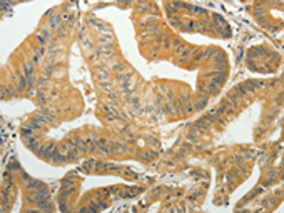 The image on the left is immunohistochemistry of paraffin-embedded Human colon cancer tissue using the antibody Antibody) at dilution 1/35, on the right is treated with fusion protein. (Original magnification: ×200)Rabbit anti-Human TAGLN2 Polyclonal Antibody