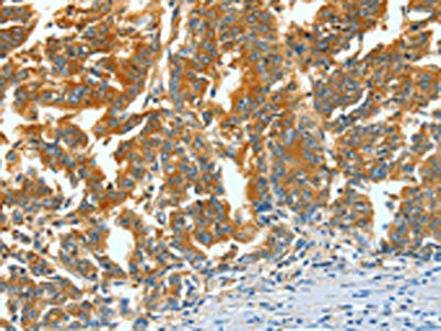 The image on the left is immunohistochemistry of paraffin-embedded Human gastric cancer tissue using ASNS Antibody(ASNS Antibody) at dilution 1/60, on the right is treated with fusion protein. (Original magnification: ×200)Rabbit anti-Human ASNS Polyclonal Antibody
