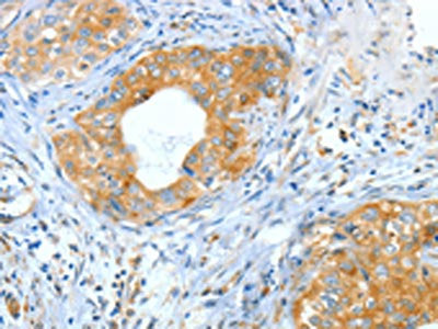The image on the left is immunohistochemistry of paraffin-embedded Human cervical cancer tissue using the antibody Antibody) at dilution 1/60, on the right is treated with fusion protein. (Original magnification: ×200)Rabbit anti-Human ASNS Polyclonal Antibody