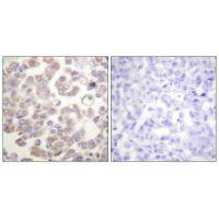 Immunohistochemistry analysis of paraffin-embedded human breast carcinoma tissue, using WNT1 antibody.Rabbit anti-Human WNT1 Polyclonal Antibody