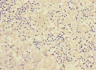 Immunohistochemistry of paraffin-embedded human liver cancer using PCDH1 Antibody at dilution of 1:100Rabbit anti-Human PCDH1 Polyclonal Antibody