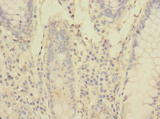 Immunohistochemistry of paraffin-embedded human colon cancer using PCDH1 Antibody at dilution of 1:100Rabbit anti-Human PCDH1 Polyclonal Antibody