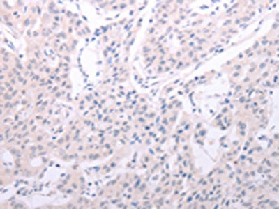 The image on the left is immunohistochemistry of paraffin-embedded Human lung cancer tissue using SPATA6 Antibody(SPATA6 Antibody) at dilution 1/40, on the right is treated with fusion protein. (Original magnification: ×200)Rabbit anti-Human SPATA6 Polyclonal Antibody