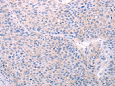 The image on the left is immunohistochemistry of paraffin-embedded Human liver cancer tissue using the antibody Antibody) at dilution 1/40, on the right is treated with fusion protein. (Original magnification: ×200)Rabbit anti-Human SPATA6 Polyclonal Antibody