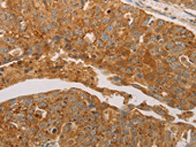 The image on the left is immunohistochemistry of paraffin-embedded Human ovarian cancer tissue using PRDX3 Antibody(PRDX3 Antibody) at dilution 1/50, on the right is treated with synthetic peptide. (Original magnification: ×200)Rabbit anti-Human PRDX3 Polyclonal Antibody