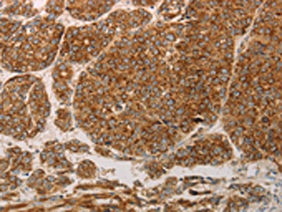 The image on the left is immunohistochemistry of paraffin-embedded Human liver cancer tissue using the antibody Antibody) at dilution 1/50, on the right is treated with synthetic peptide. (Original magnification: ×200)Rabbit anti-Human PRDX3 Polyclonal Antibody