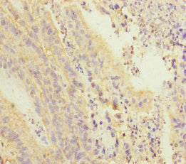 Immunohistochemistry of paraffin-embedded human colon cancer using PDE6A Antibody at dilution of 1:100Rabbit anti-Human PDE6A Polyclonal Antibody