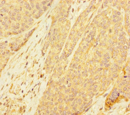 Immunohistochemistry of paraffin-embedded human ovarian cancer using PDE6A Antibody at dilution of 1:100Rabbit anti-Human PDE6A Polyclonal Antibody