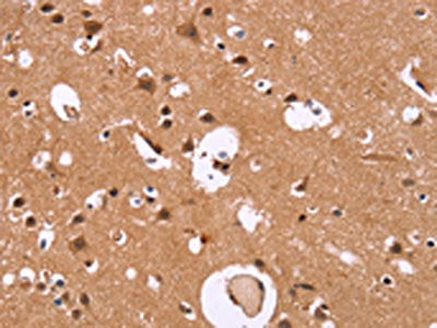 The image on the left is immunohistochemistry of paraffin-embedded Human brain  tissue using HDLBP Antibody(HDLBP Antibody) at dilution 1/30, on the right is treated with synthetic peptide. (Original magnification: ×200)Rabbit anti-Human HDLBP Polyclonal Antibody