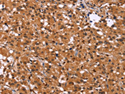 The image on the left is immunohistochemistry of paraffin-embedded Human thyroid cancer tissue using the antibody Antibody) at dilution 1/30, on the right is treated with synthetic peptide. (Original magnification: ×200)Rabbit anti-Human HDLBP Polyclonal Antibody
