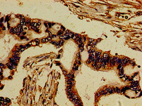 Immunohistochemistry of paraffin-embedded human pancreatic cancer using the antibody at dilution of 1:100Rabbit anti-Human ROR2 Polyclonal Antibody