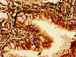 Immunohistochemistry of paraffin-embedded human lung cancer using ROR2 Antibody at dilution of 1:100Rabbit anti-Human ROR2 Polyclonal Antibody