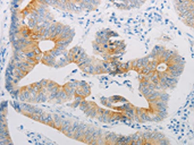 The image on the left is immunohistochemistry of paraffin-embedded Human colon cancer tissue using ADRB2 Antibody(ADRB2 Antibody) at dilution 1/20, on the right is treated with synthetic peptide. (Original magnification: ×200)Rabbit anti-Human ADRB2 Polyclonal Antibody
