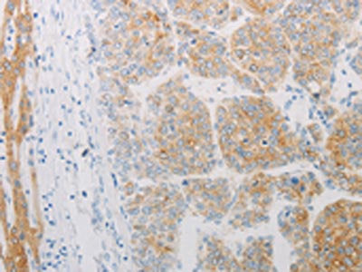 The image on the left is immunohistochemistry of paraffin-embedded Human liver cancer tissue using the antibody Antibody) at dilution 1/20, on the right is treated with synthetic peptide. (Original magnification: ×200)
