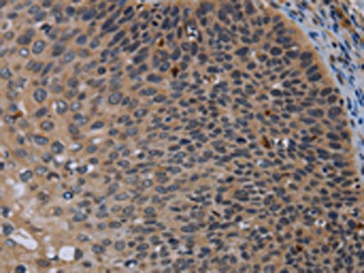 The image on the left is immunohistochemistry of paraffin-embedded Human cervical cancer tissue using P2RX2 Antibody(P2RX2 Antibody) at dilution 1/50, on the right is treated with synthetic peptide. (Original magnification: ×200)Rabbit anti-Human P2RX2 Polyclonal Antibody